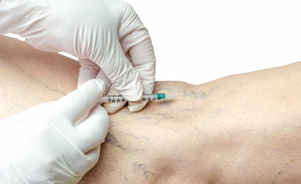 Sclerotherapy in Dubai - German Medical Center