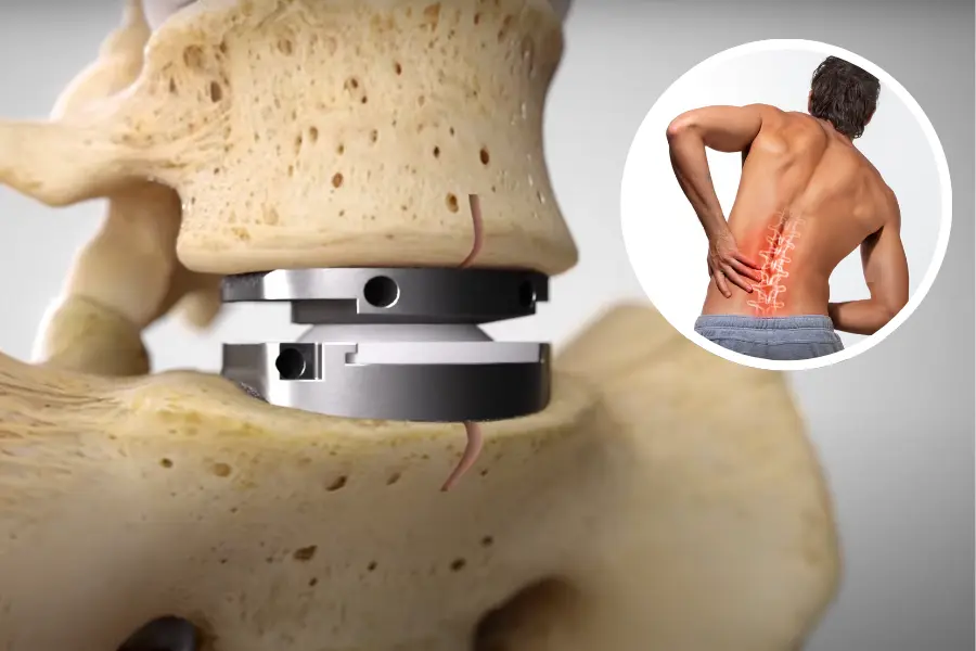 Spinal disc replacement - Dr. Pawel Zwolak - German Medical Center